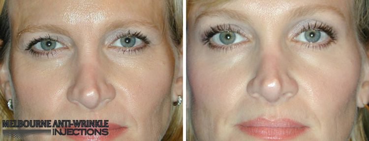 Botox Anti-Wrinkle Injections in Melbourne