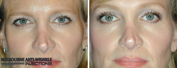 Botox Anti-Wrinkle Injections in Melbourne