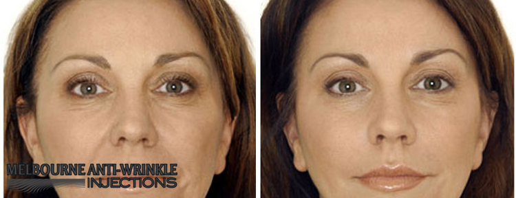 Melbourne clinic specialists in Botox anti-wrinkle injections to remove facial wrinkles