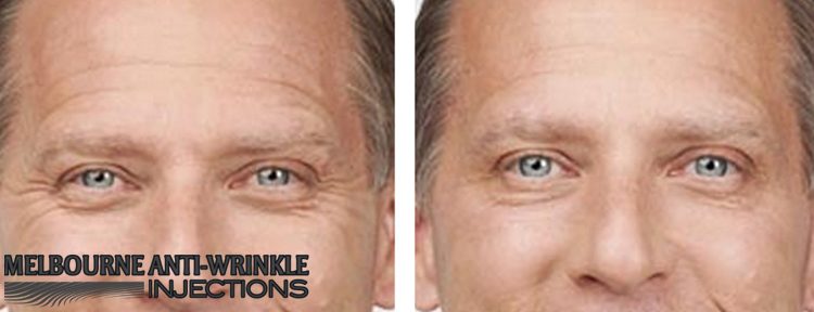 Forehead wrinkles and frown lines removal with Botox injections at Melbourne Anti-Wrinkle Injections