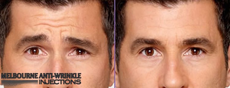 Botox Injections at Melbourne Anti-Wrinkle Injections