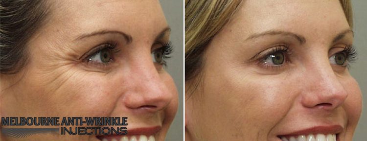 Botox Anti-Wrinkle Injections Results