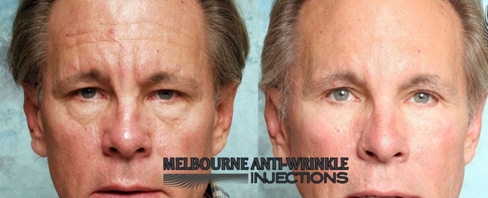 Botox Injections to remove forehead wrinkles at our Melbourne Clinic