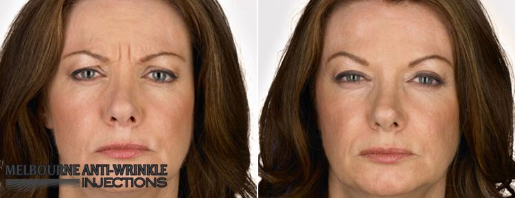 Botox Anti-Wrinkle Injections Results