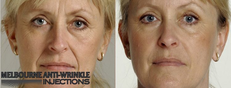 Botox Melbourne - Melbourne Anti-Wrinkle Injections 23 Black St, Brighton VIC 3186, Melbourne VIC 3004 1300 854 553