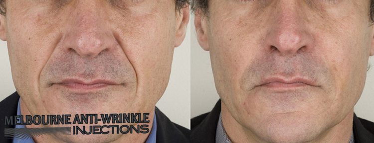 Botox Melbourne - Melbourne Anti-Wrinkle Injections 23 Black St, Brighton VIC 3186, Melbourne VIC 3004 1300 854 553 Melbourne Botox Anti-Wrinkle Injections Clinic for dermal fillers