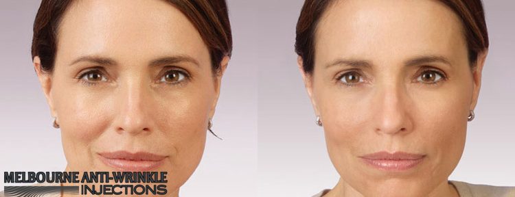 Dermal and Lip Injections - Melbourne Anti-Wrinkle Injections 23 Black St, Brighton VIC 3186, Melbourne VIC 3004 1300 854 553 Melbourne Anti-Wrinkle Injections Dermal Fillers eyebrow lift and lip fillers