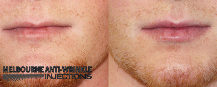 Lip Enhancement with Dermal Filler Injections at Melbourne Anti-Wrinkle Injections